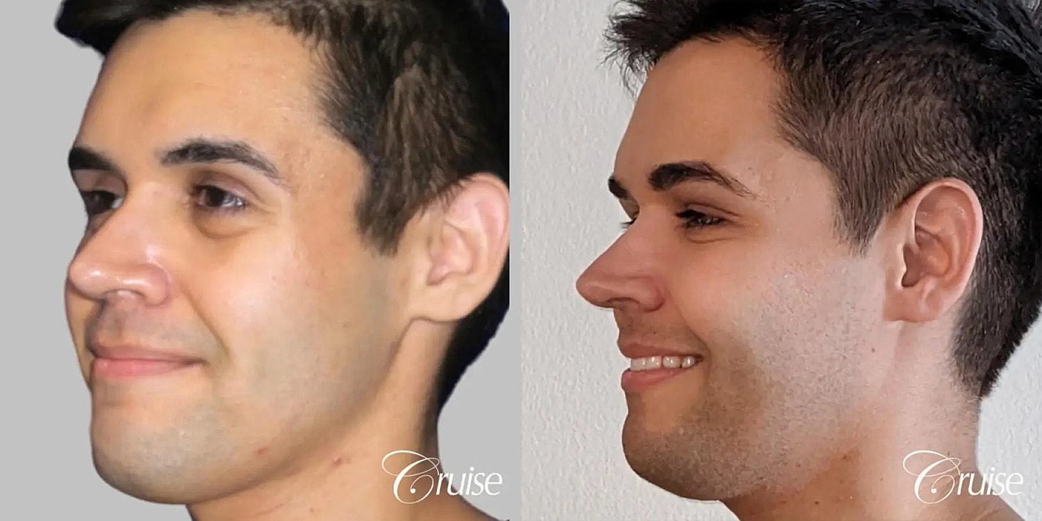 Facial Fat Transfer Before & After
