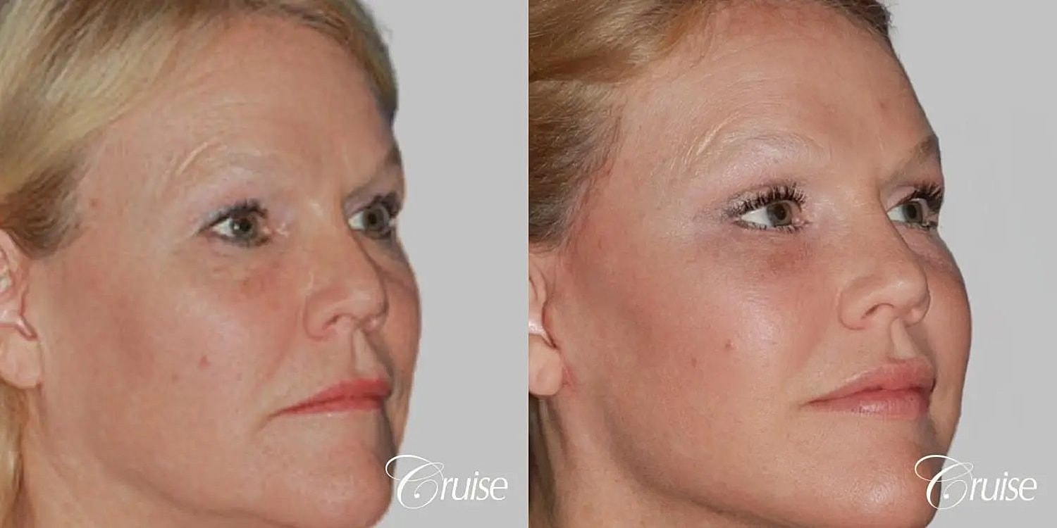 Facial Fat Transfer Before & After
