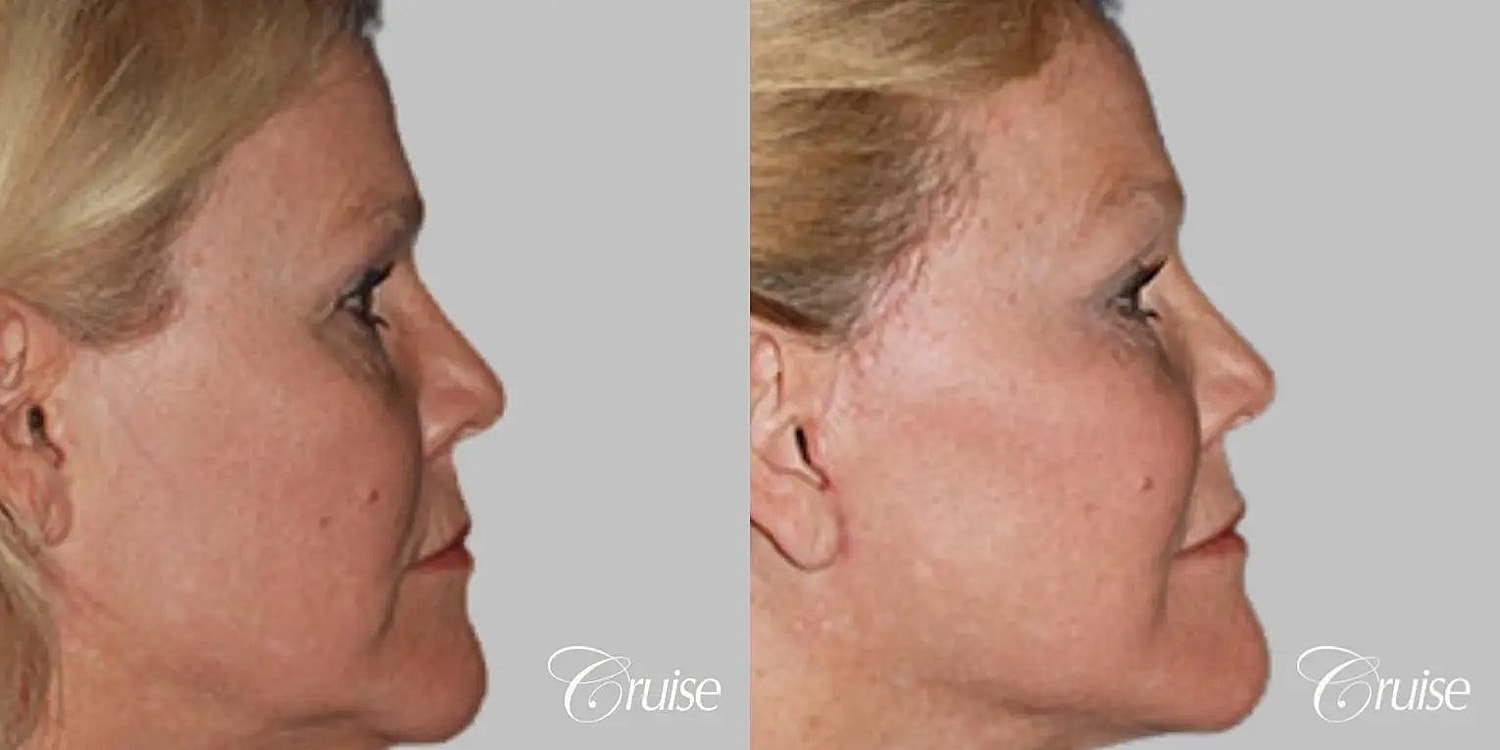 Facial Fat Transfer Before & After