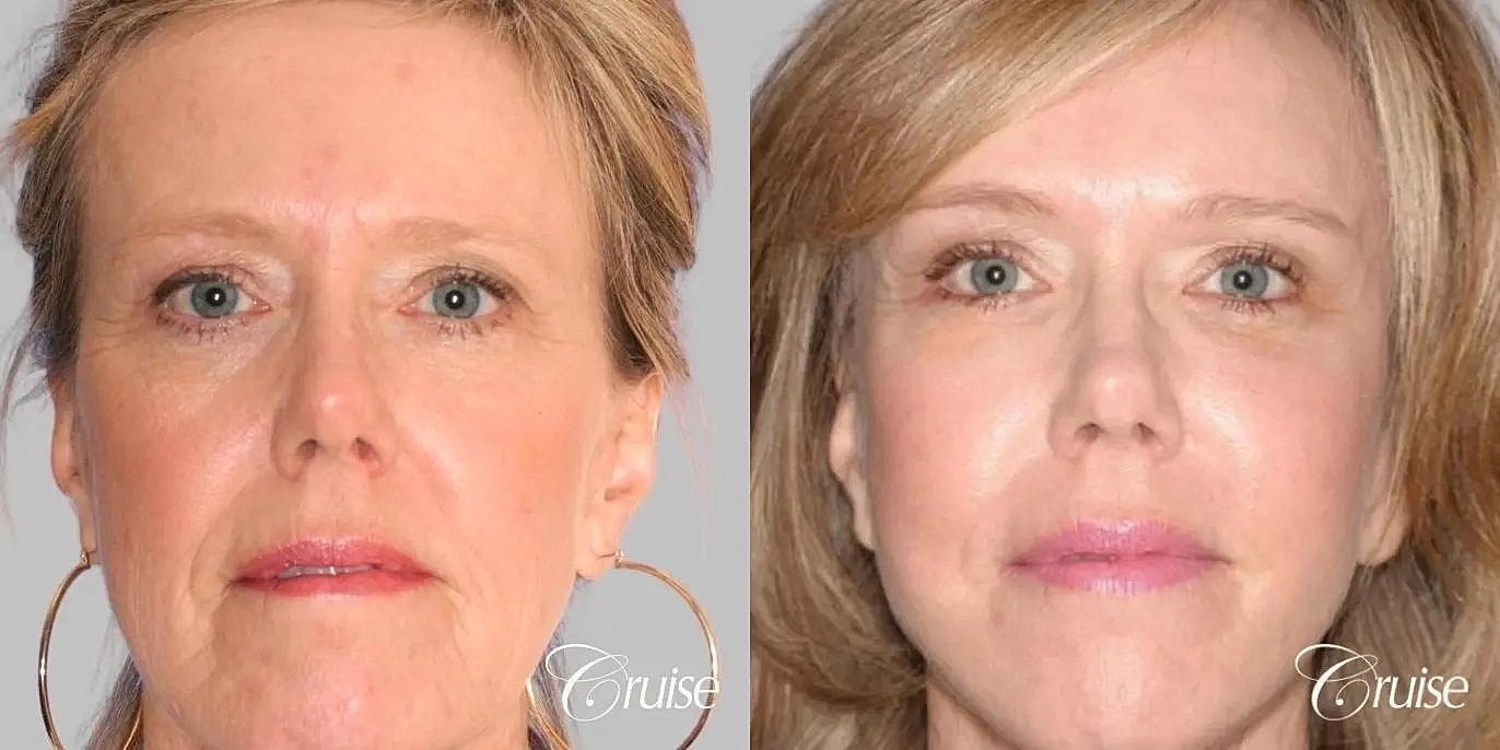 Facial Fat Transfer Before & After