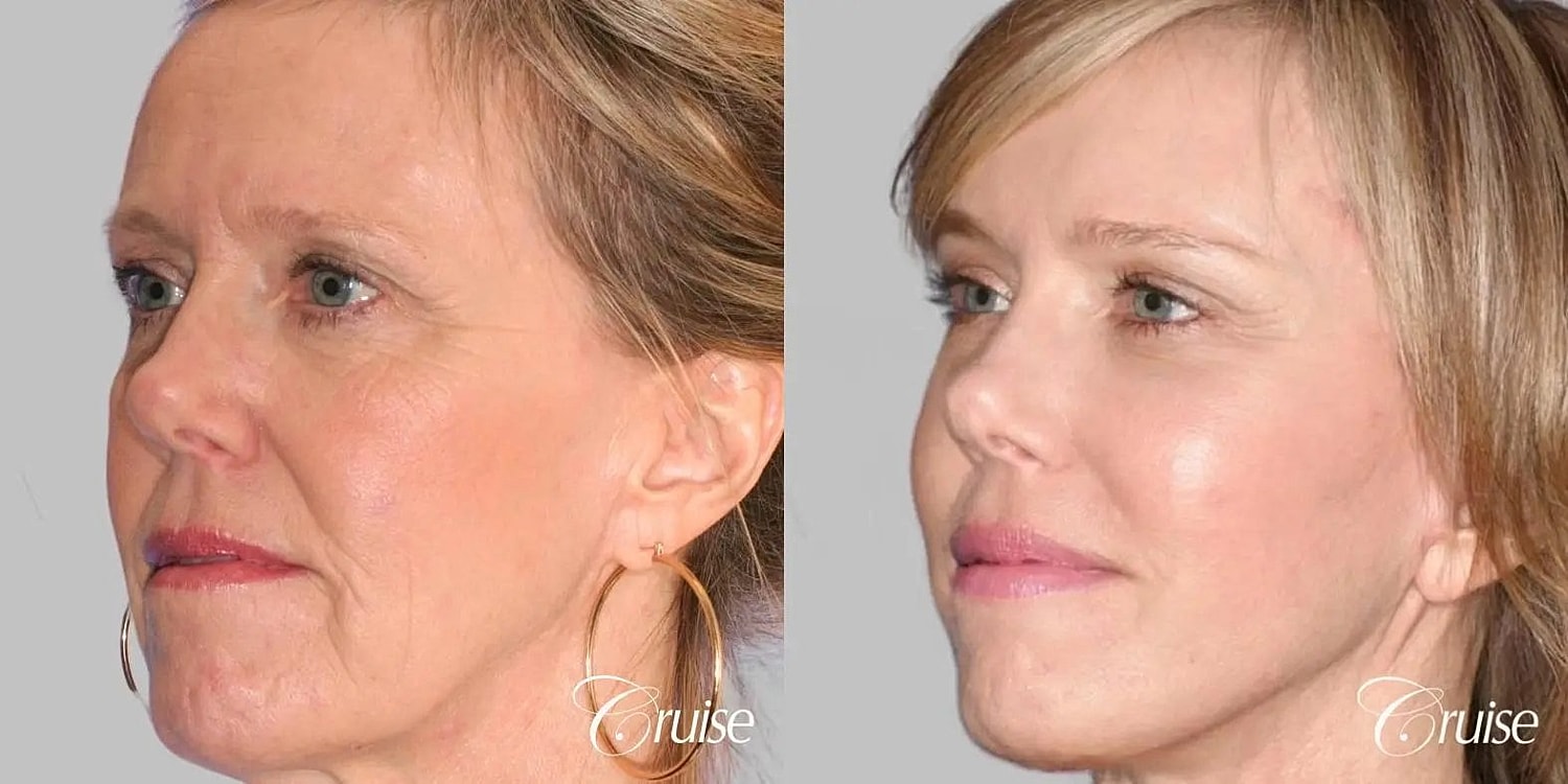Facial Fat Transfer Before & After
