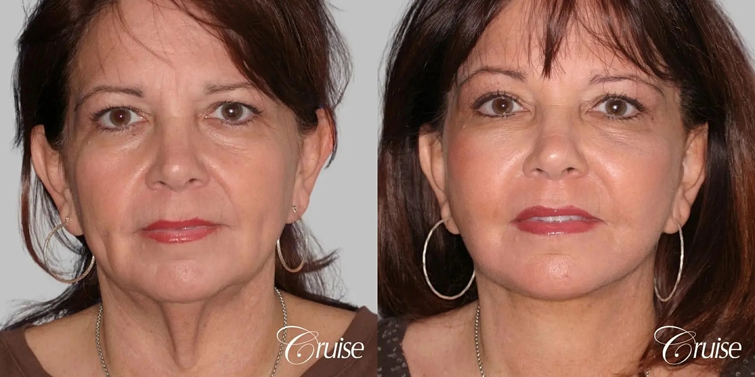 Facial Fat Transfer Before & After