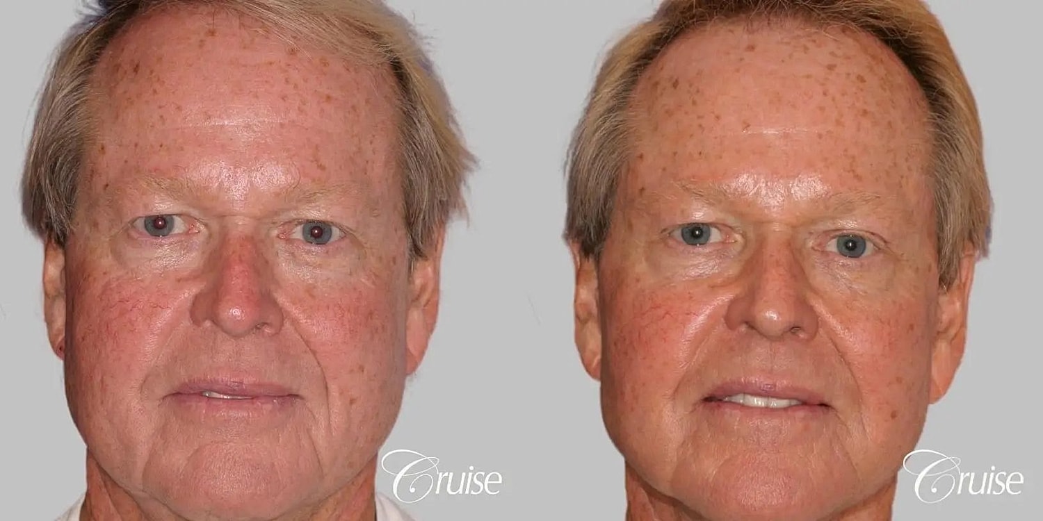 Facial Fat Transfer Before & After