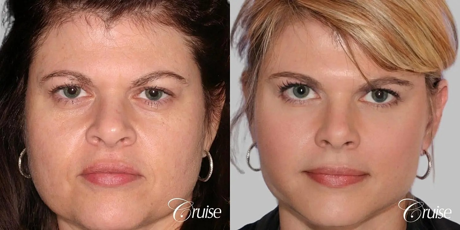 Facial Fat Transfer Before & After