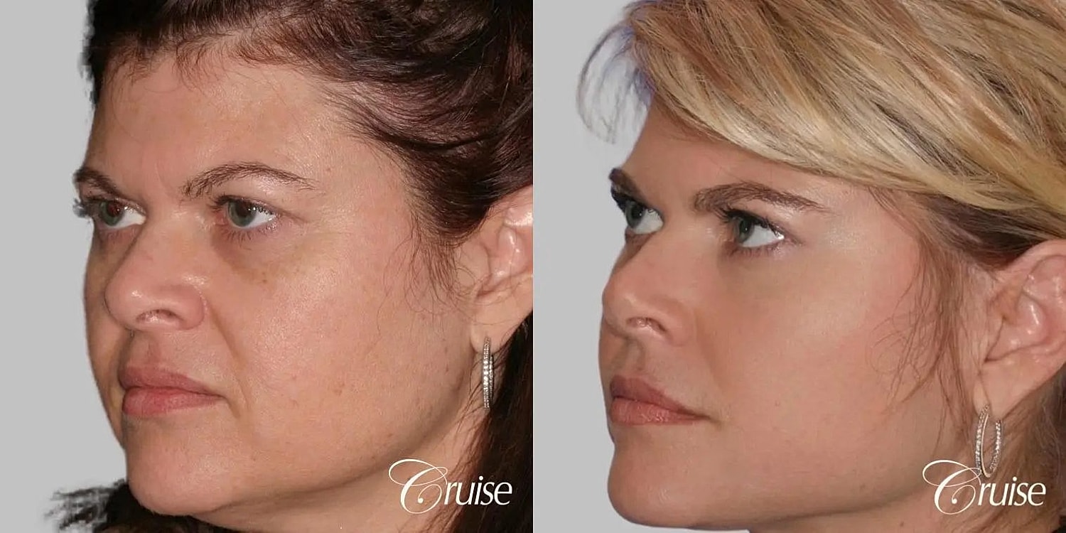 Facial Fat Transfer Before & After