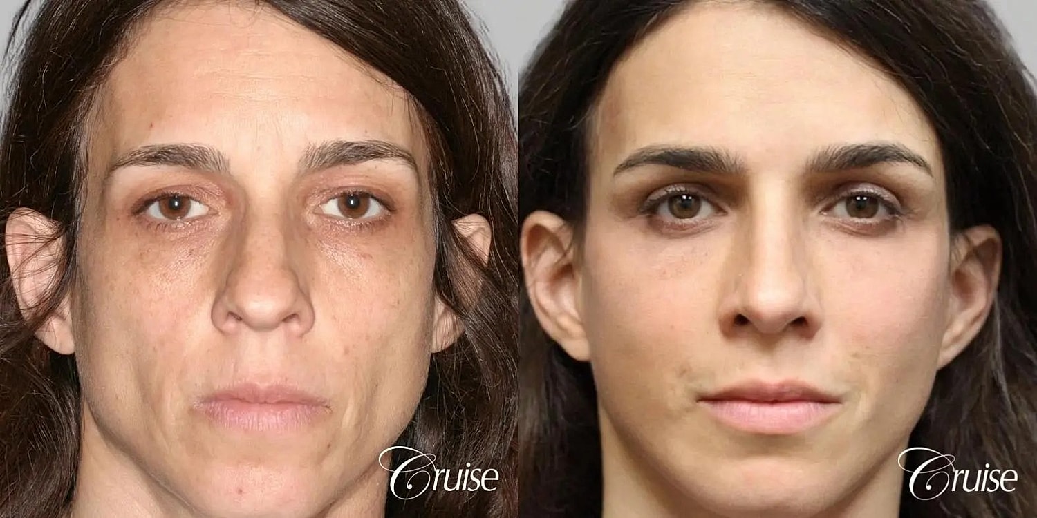Facial Fat Transfer Before & After