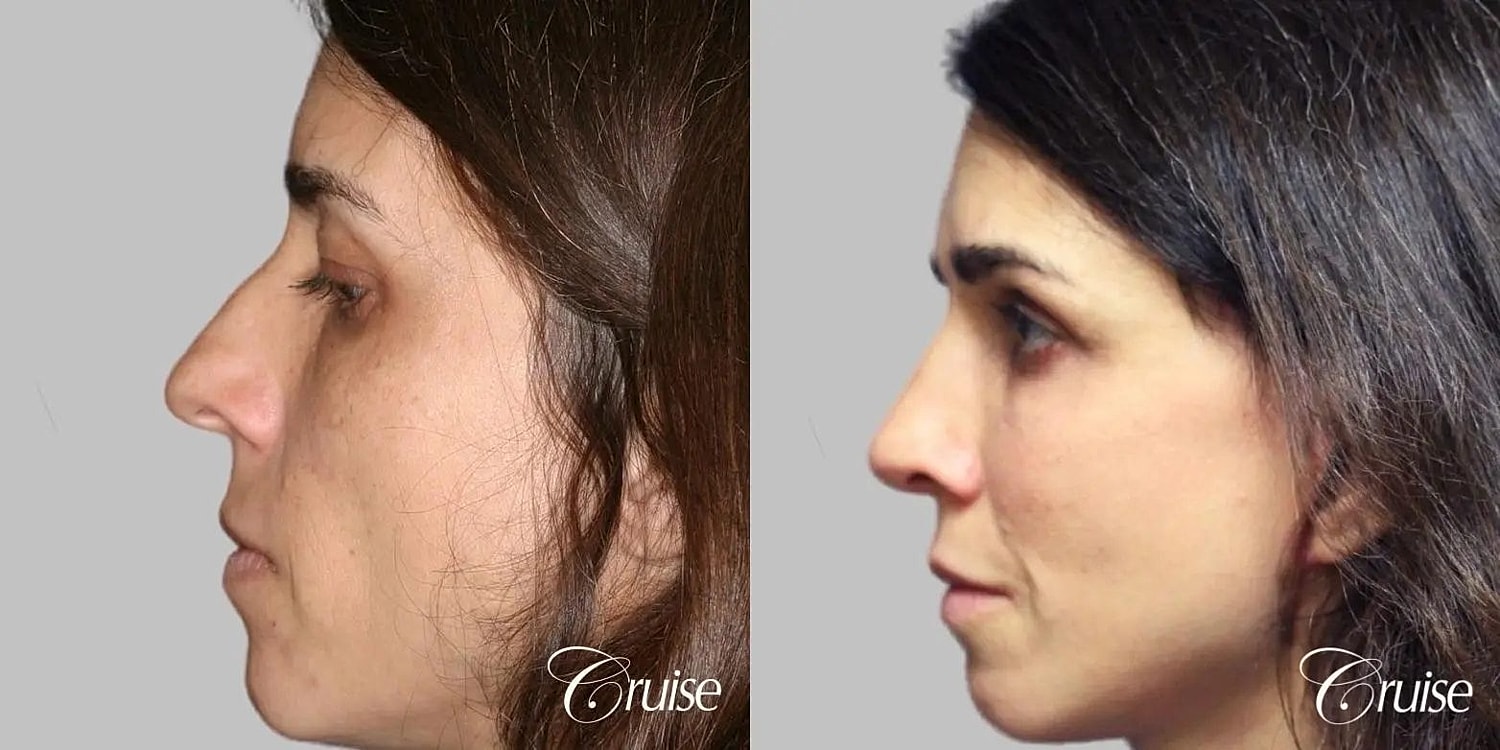 Facial Fat Transfer Before & After