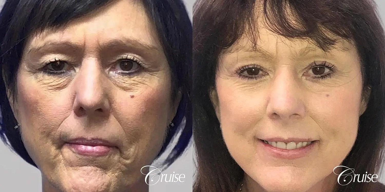 Facial Fat Transfer Before & After