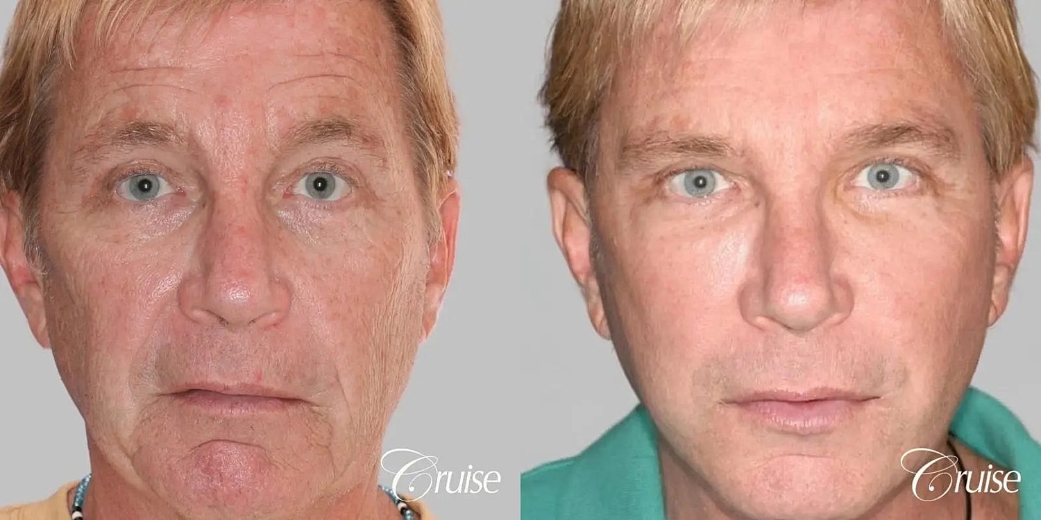 Facial Fat Transfer Before & After