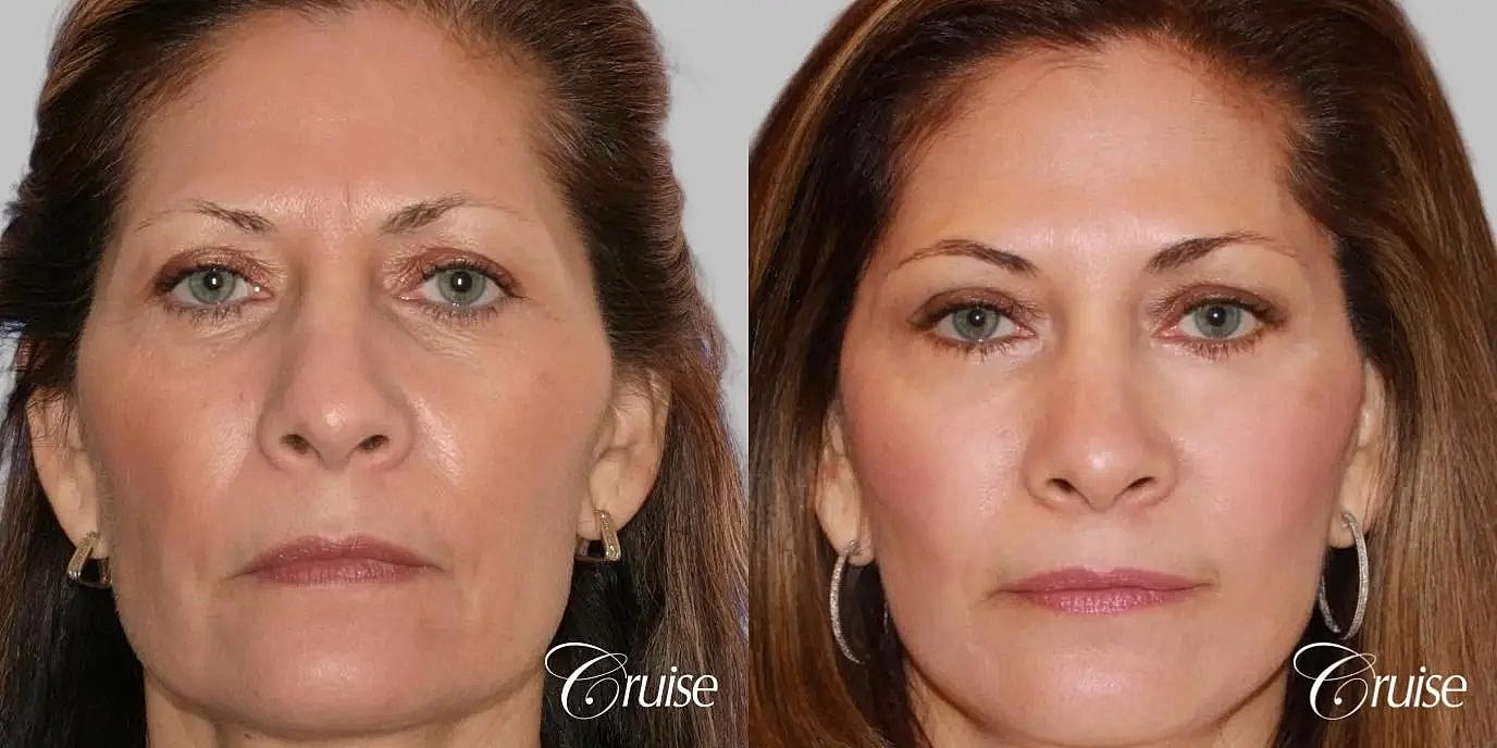 Facial Fat Transfer Before & After