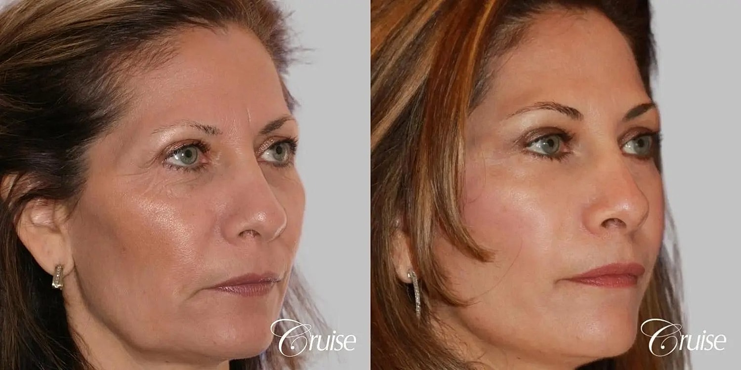 Facial Fat Transfer Before & After