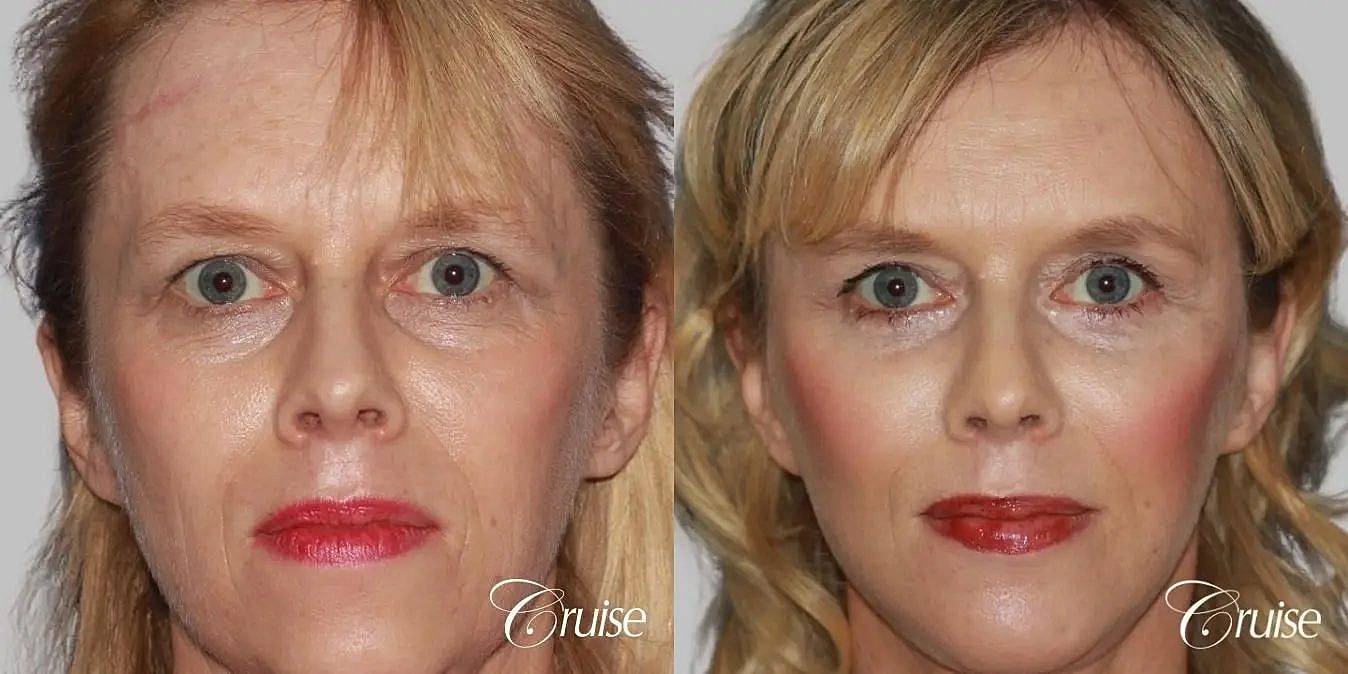 Facial Fat Transfer Before & After
