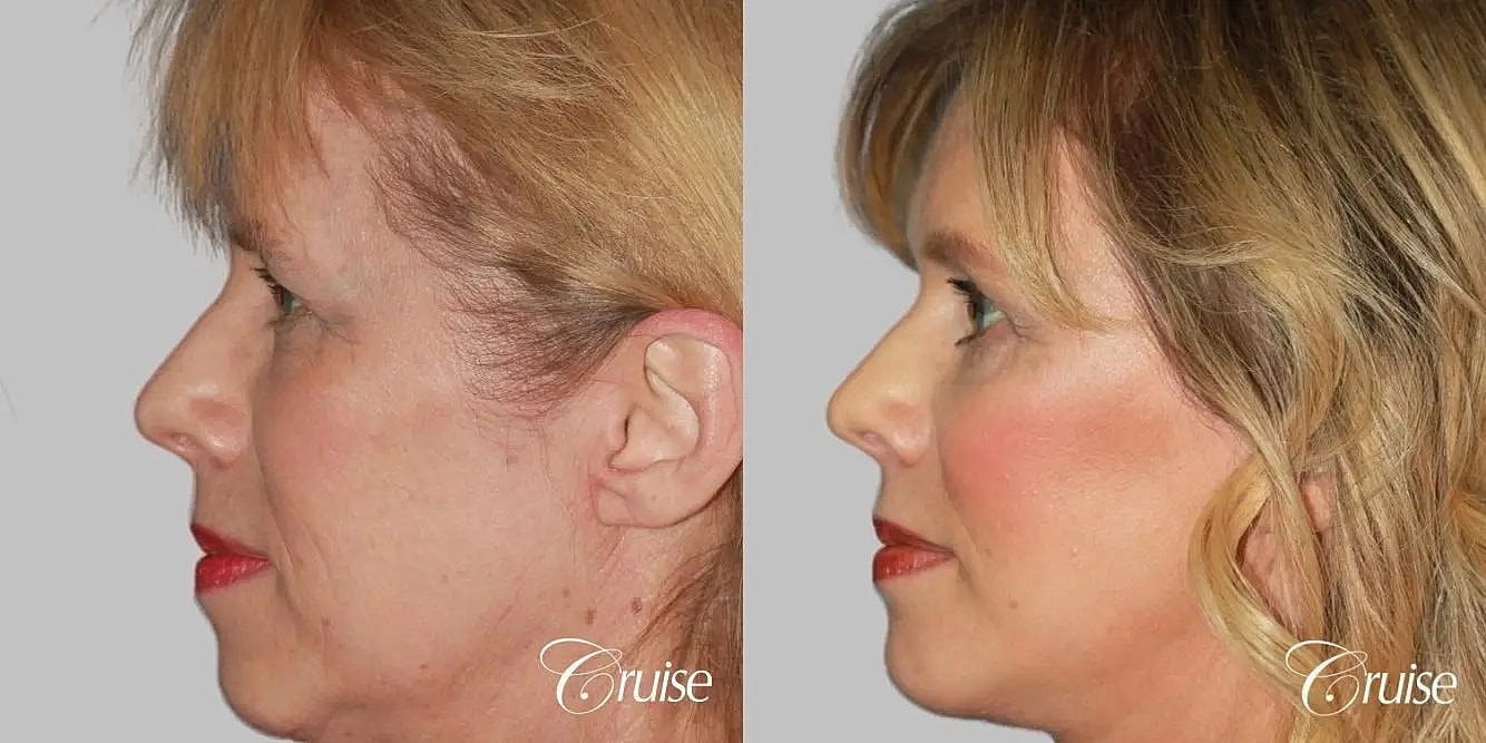 Facial Fat Transfer Before & After