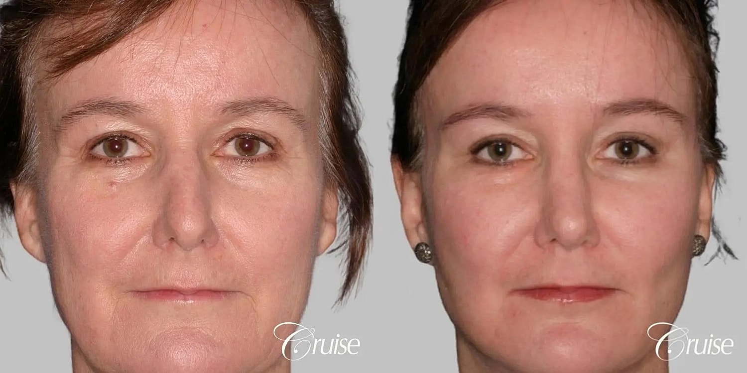 Facial Fat Transfer Before & After