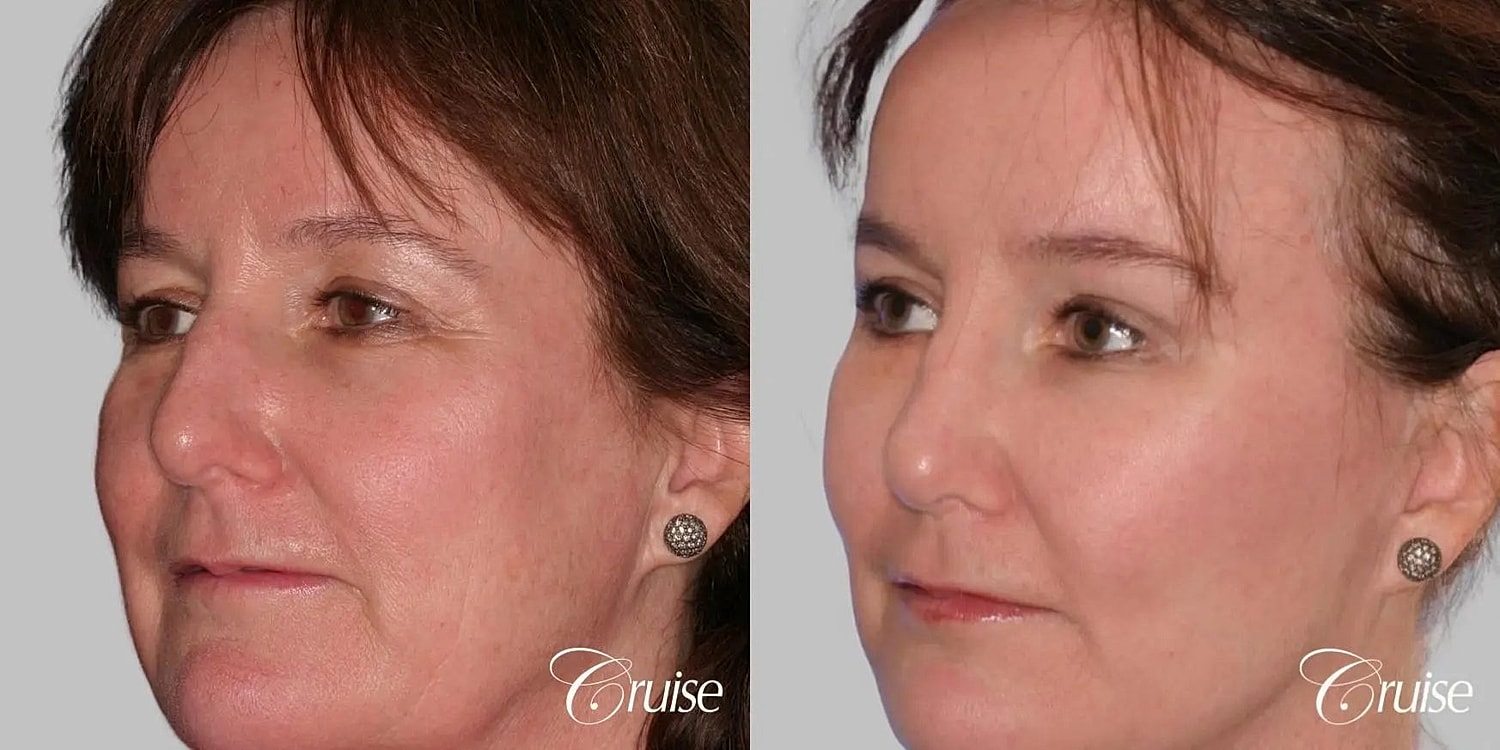 Facial Fat Transfer Before & After