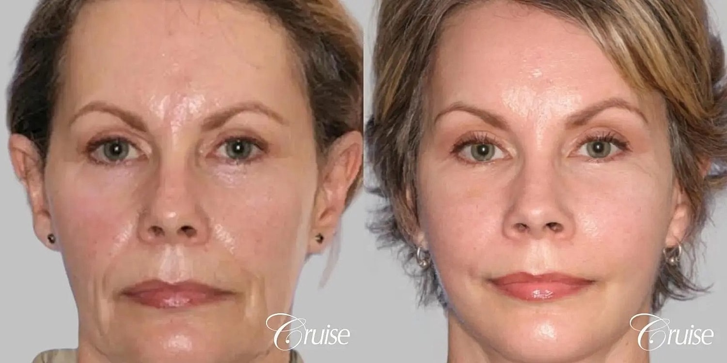 Facial Fat Transfer Before & After