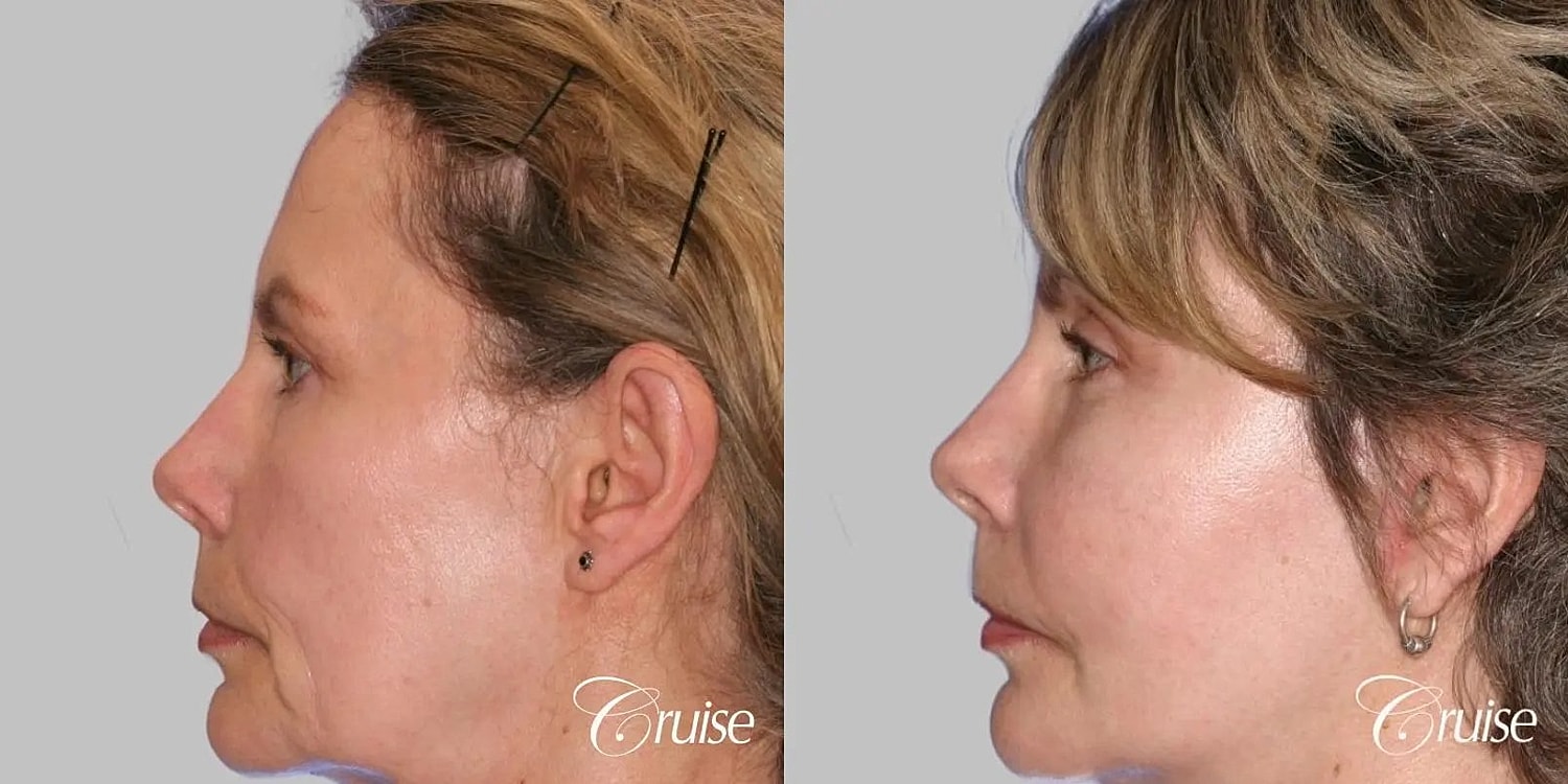 Facial Fat Transfer Before & After