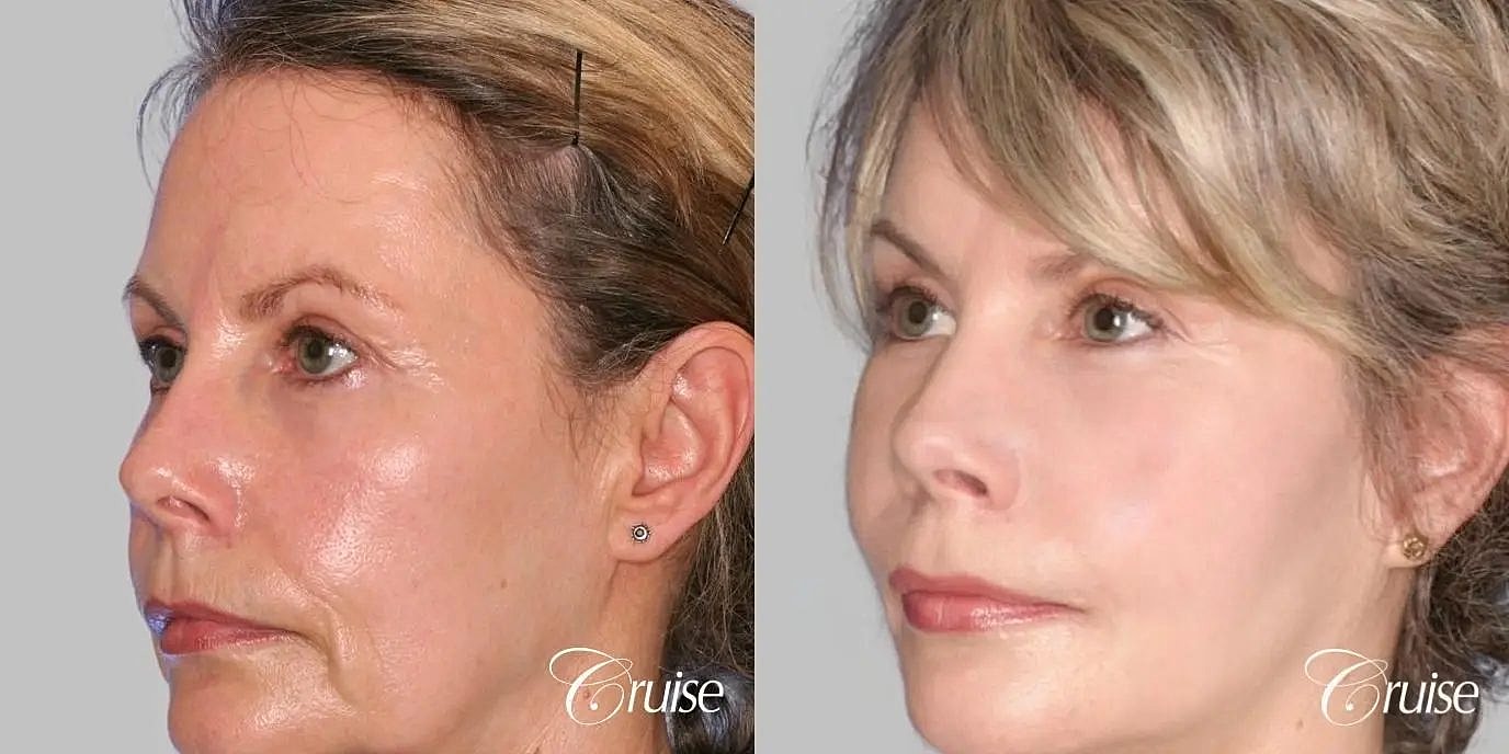Facial Fat Transfer Before & After