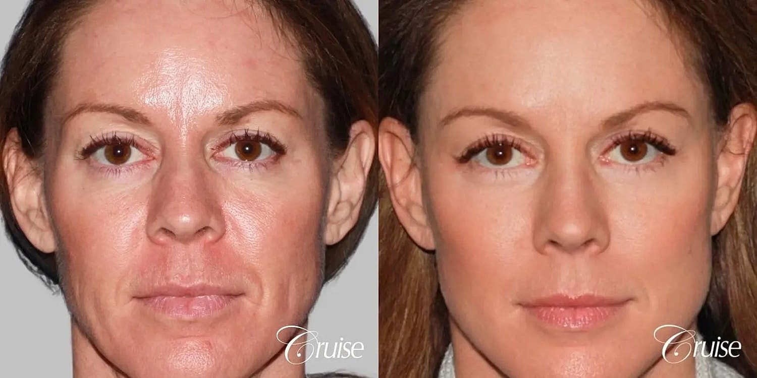 Facial Fat Transfer Before & After