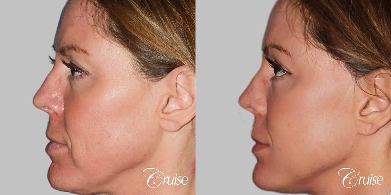 Facial Fat Transfer Before & After