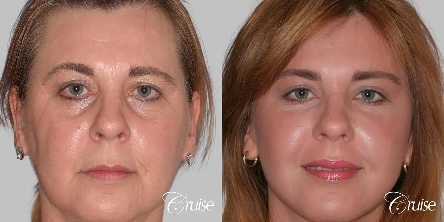 Facial Fat Transfer Before & After