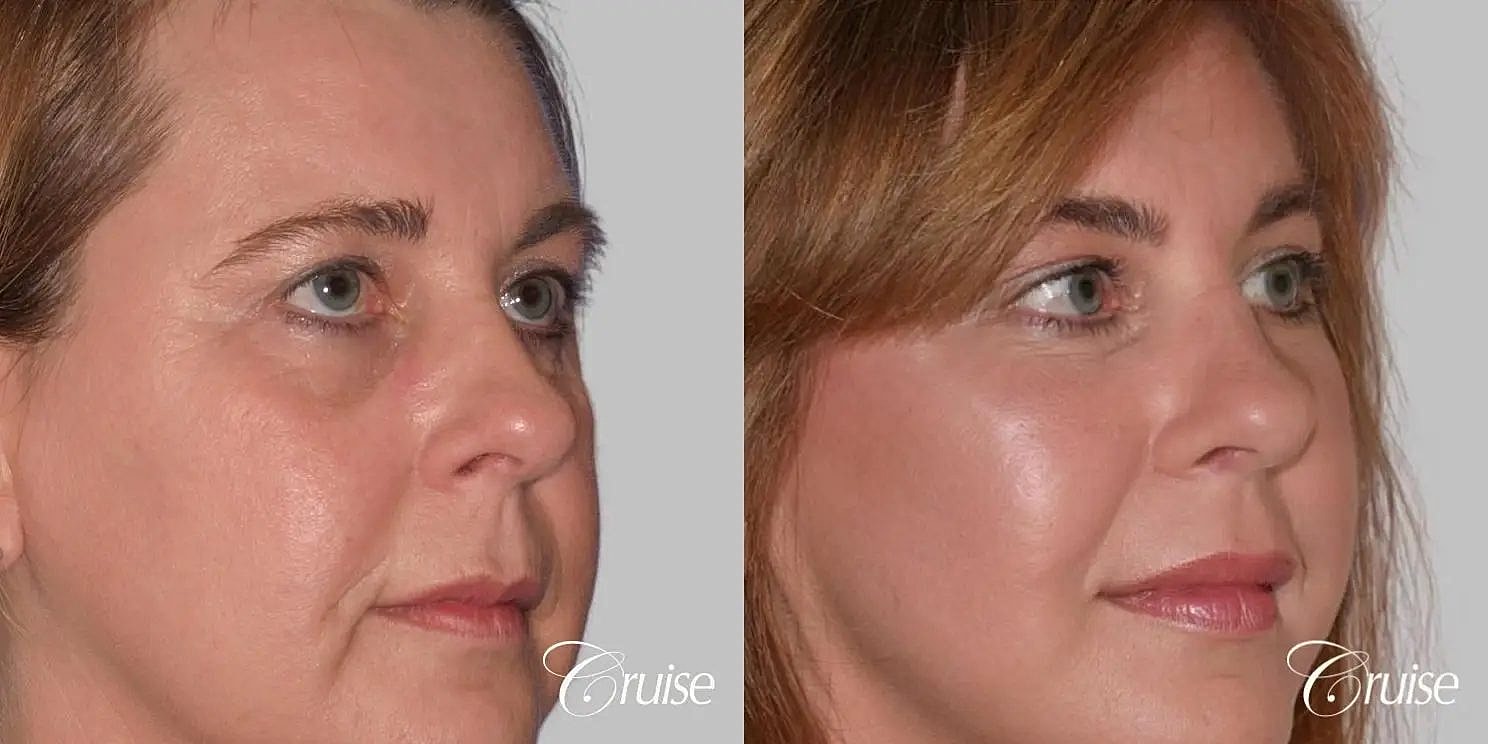 Facial Fat Transfer Before & After
