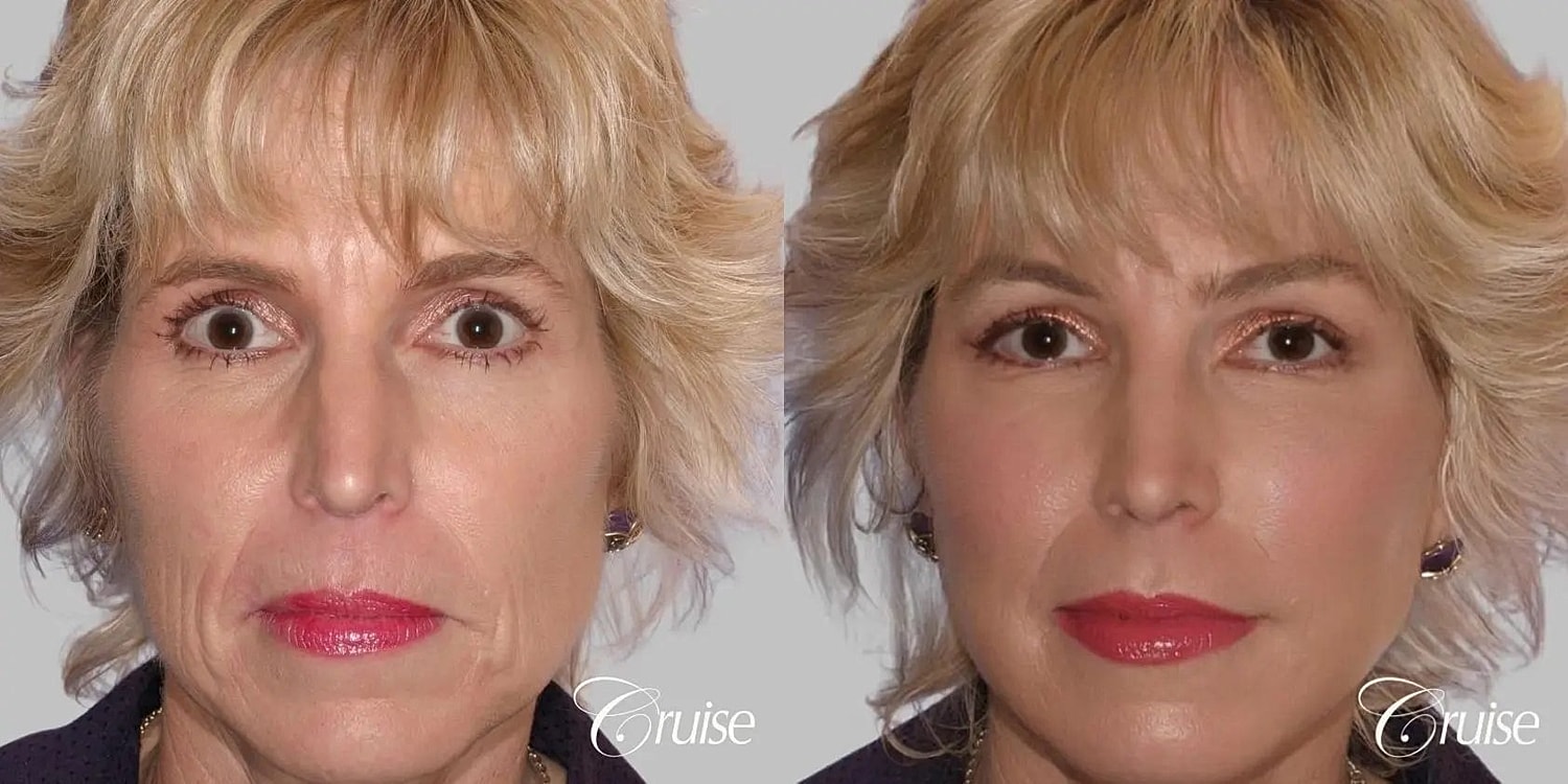 Facial Fat Transfer Before & After