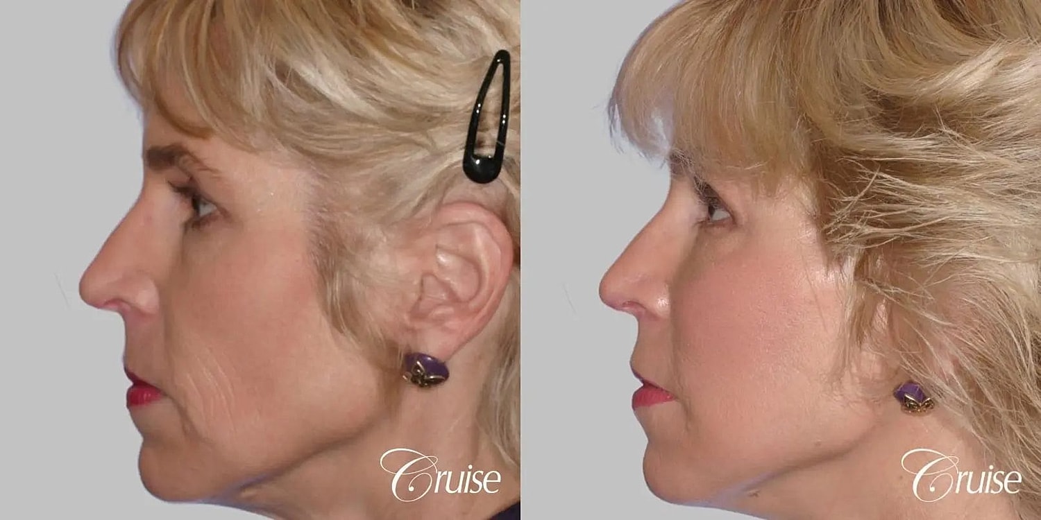 Facial Fat Transfer Before & After