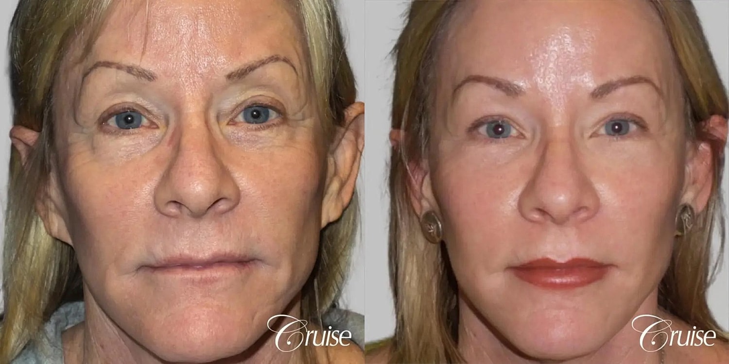Facial Fat Transfer Before & After