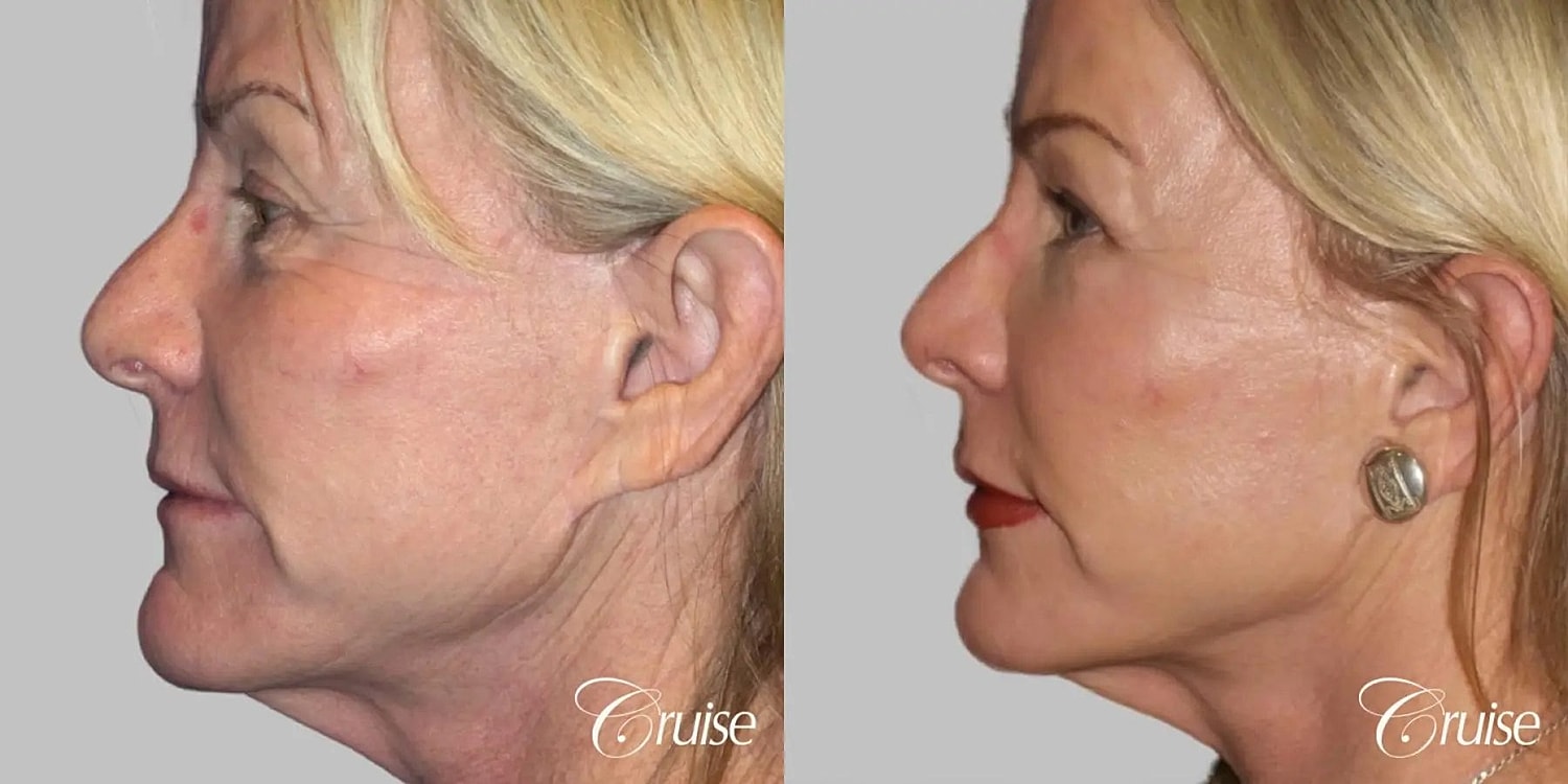 Facial Fat Transfer Before & After