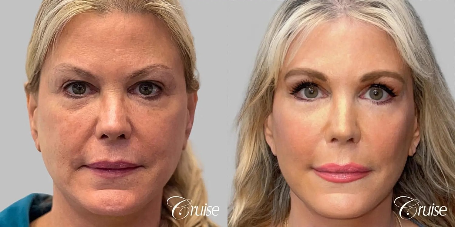 Facial Fat Transfer Before & After