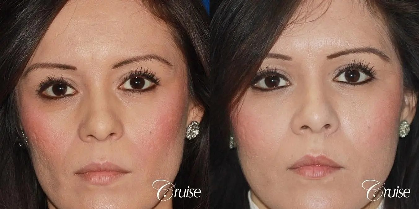 Facial Fat Transfer Before & After