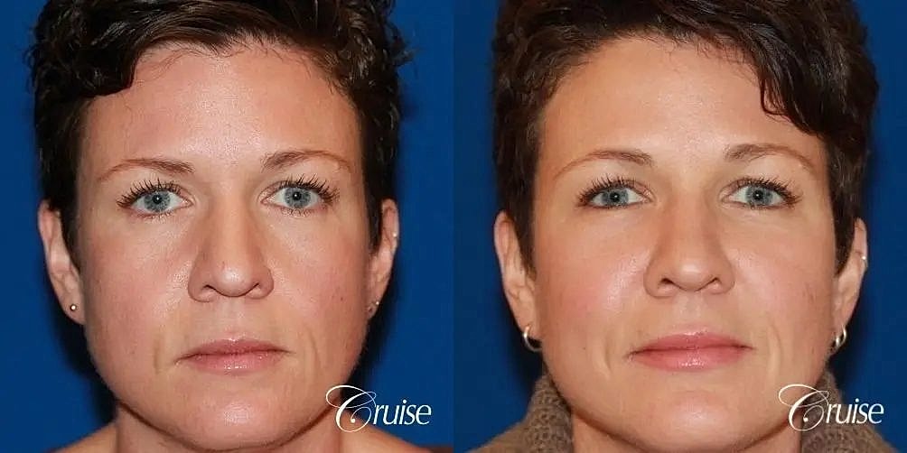 Facial Fat Transfer Before & After