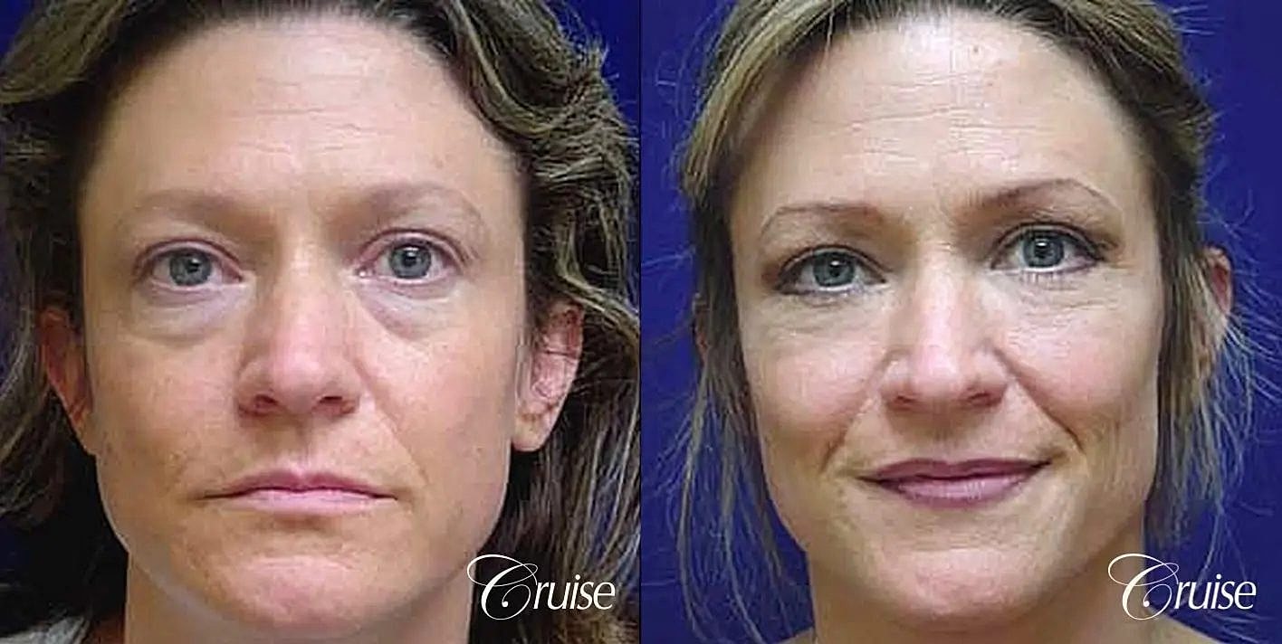 Facial Fat Transfer Before & After