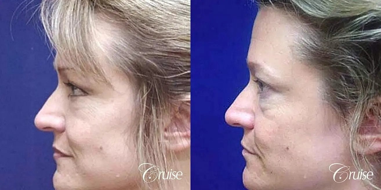 Facial Fat Transfer Before & After