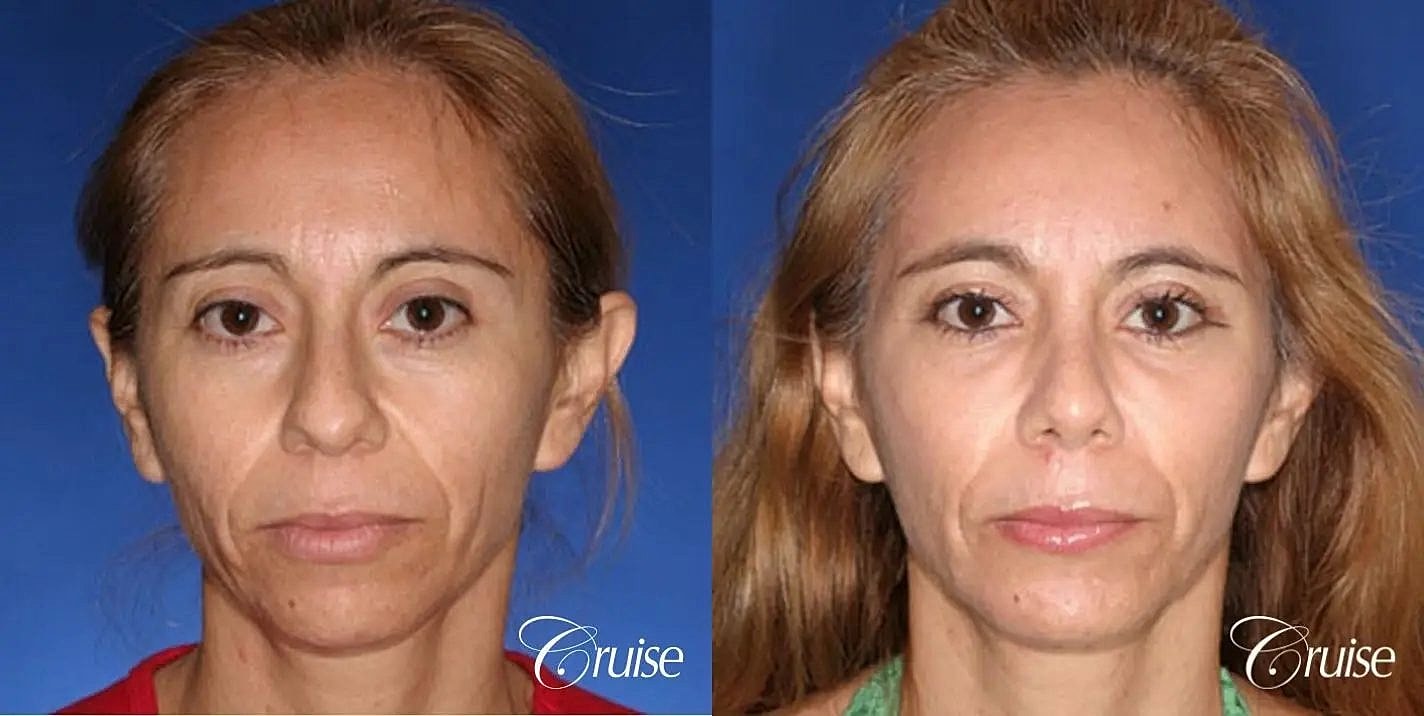 Facial Fat Transfer Before & After