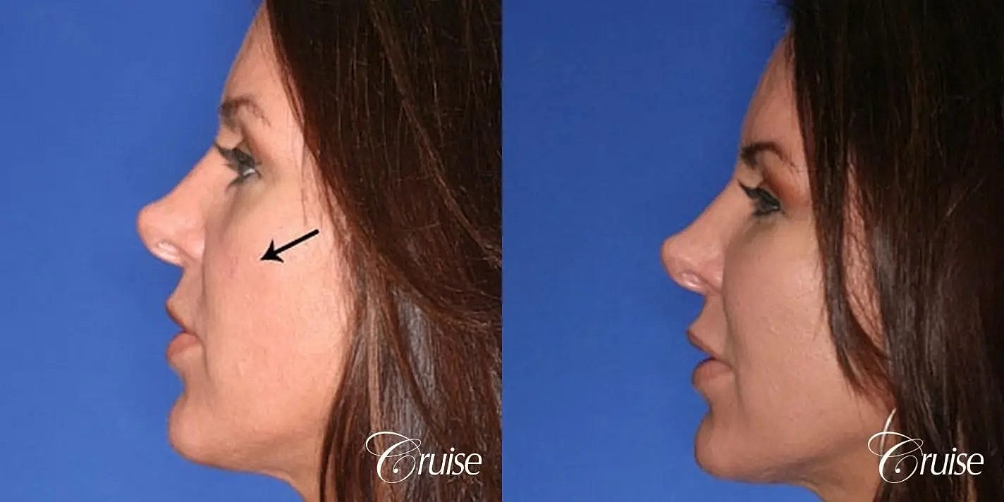 Facial Fat Transfer Before & After