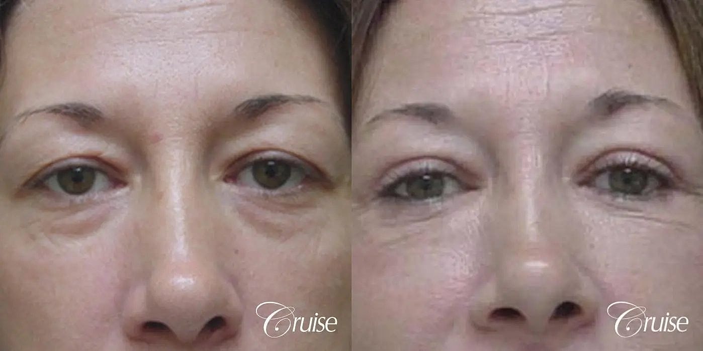 Facial Fat Transfer Before & After
