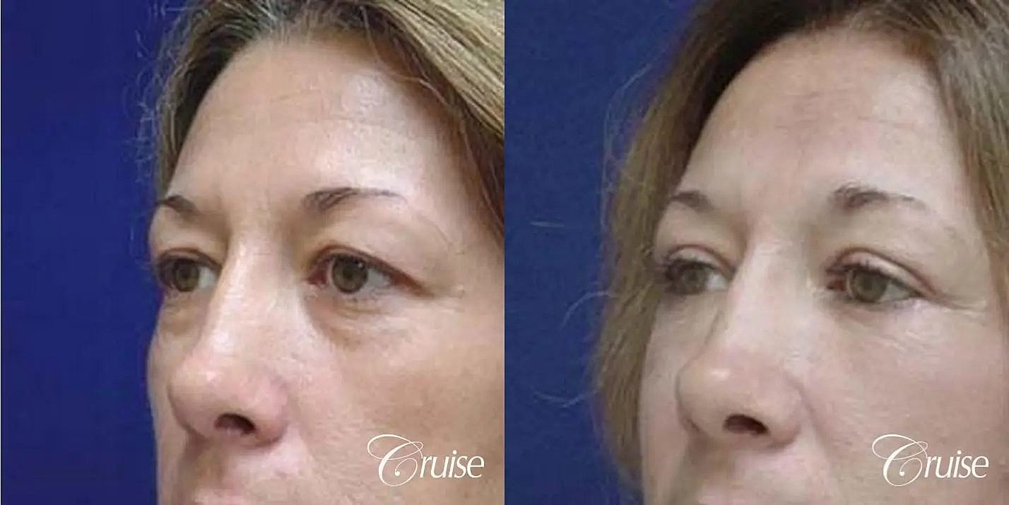 Facial Fat Transfer Before & After