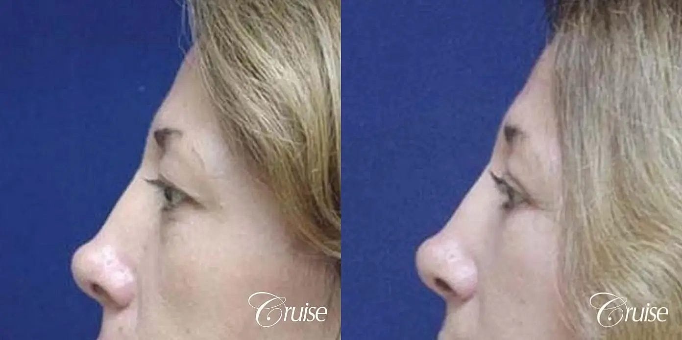Facial Fat Transfer Before & After