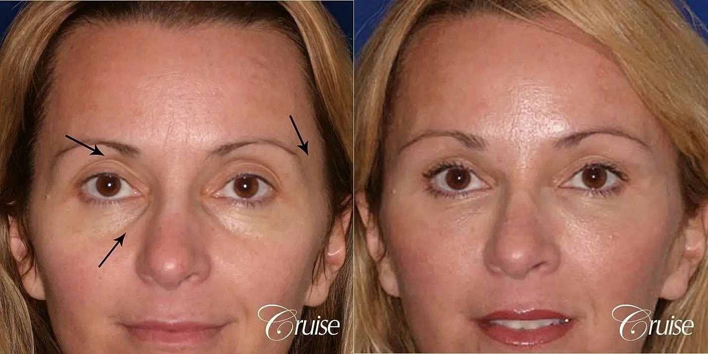 Facial Fat Transfer Before & After
