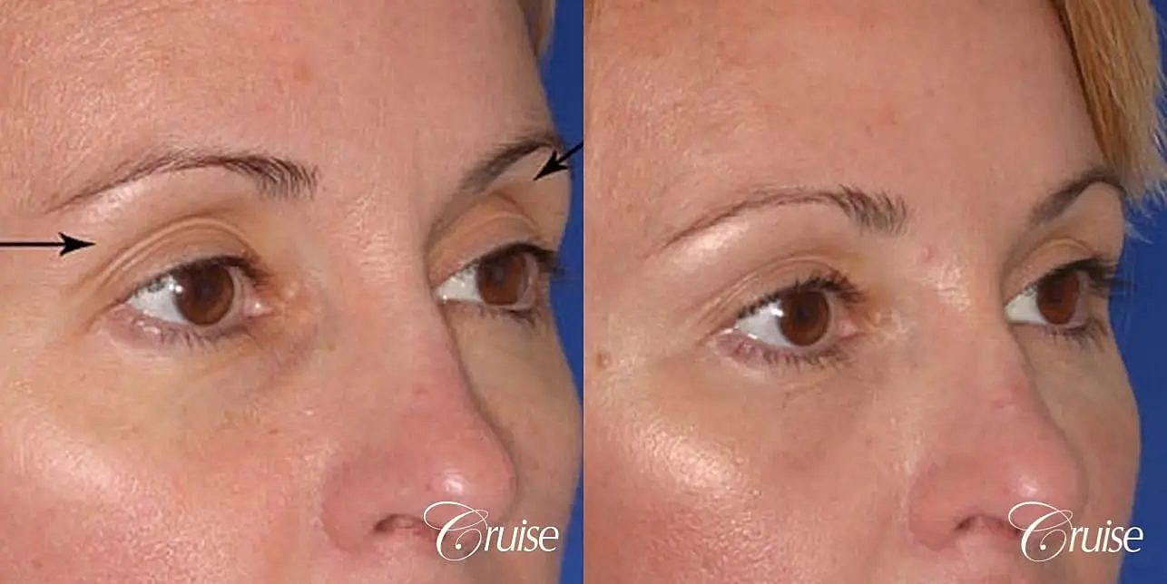 Facial Fat Transfer Before & After