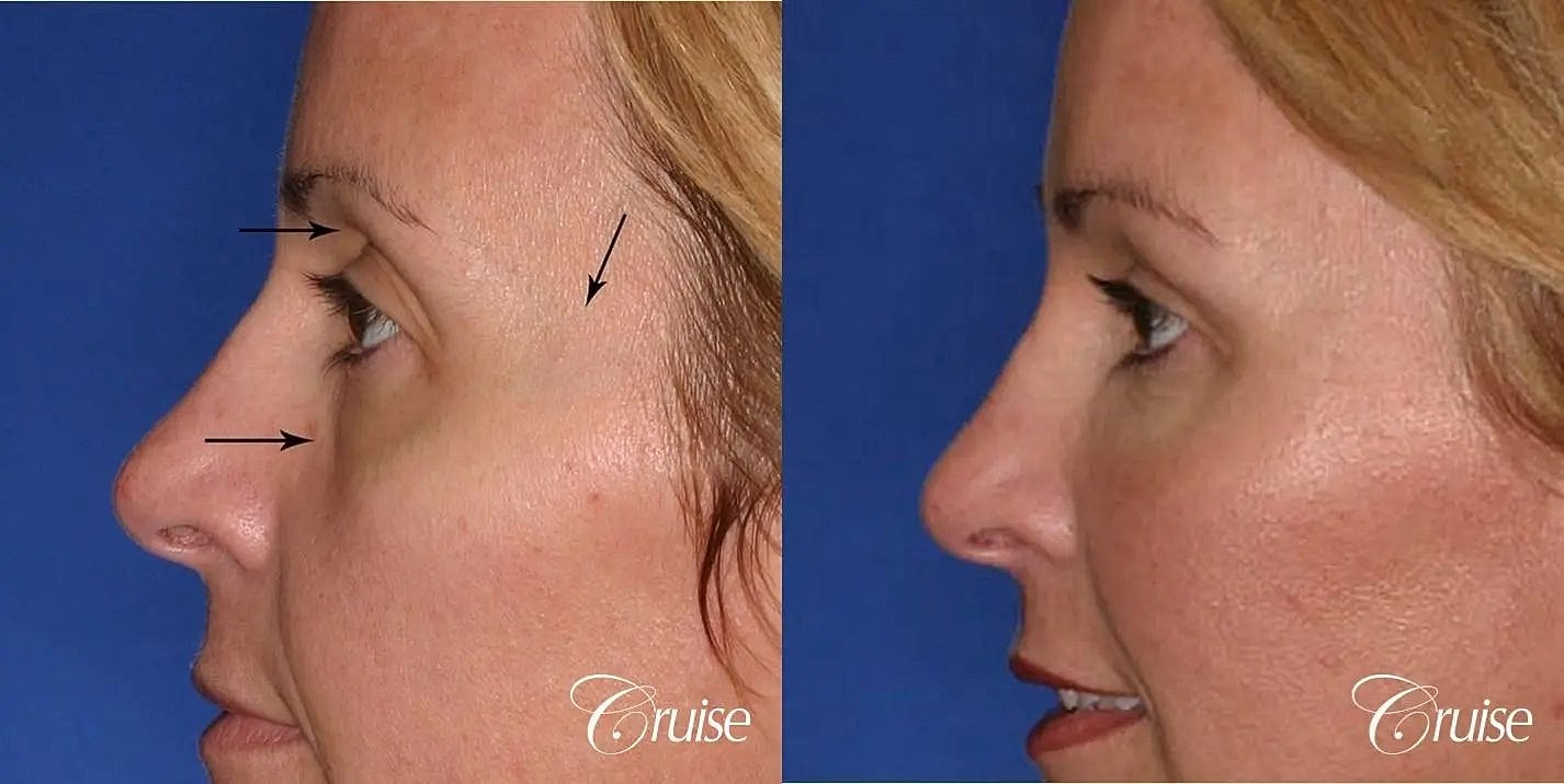 Facial Fat Transfer Before & After