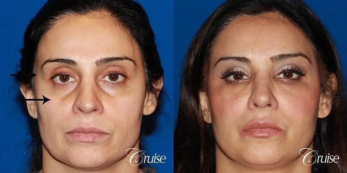 Facial Fat Transfer Before & After