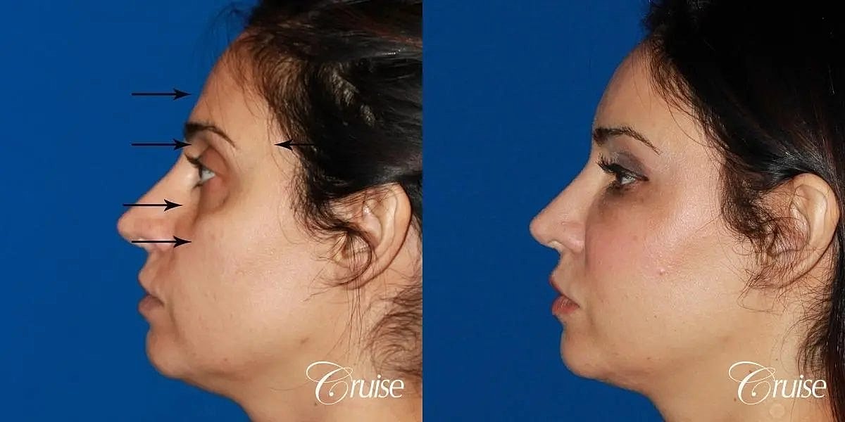 Facial Fat Transfer Before & After
