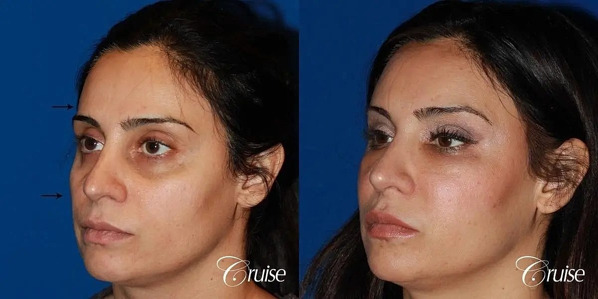 Facial Fat Transfer Before & After