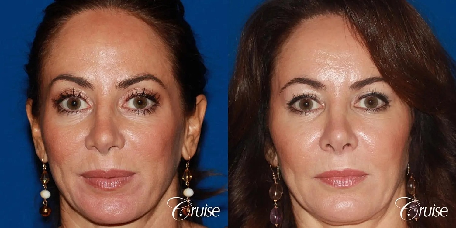 Facial Fat Transfer Before & After