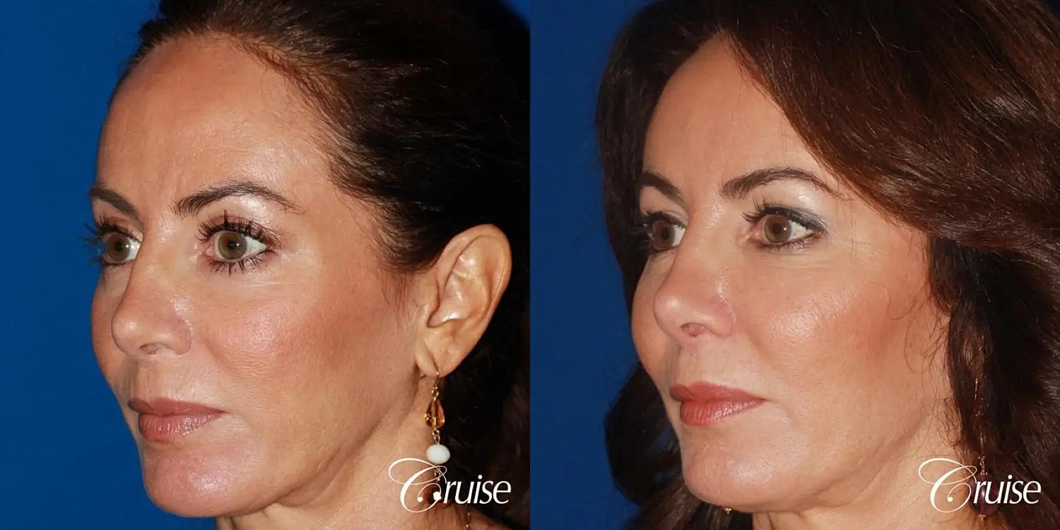 Facial Fat Transfer Before & After