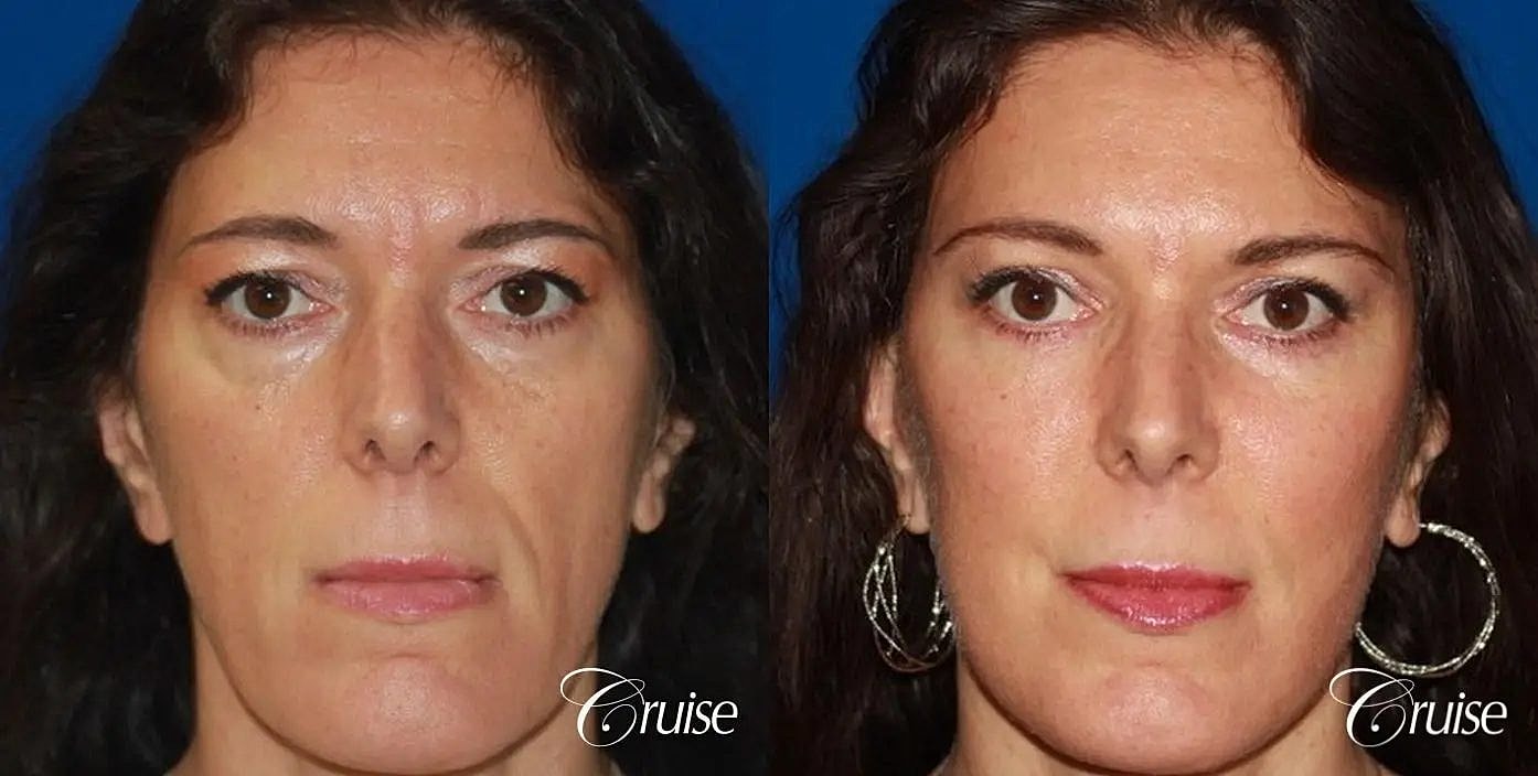 Facial Fat Transfer Before & After
