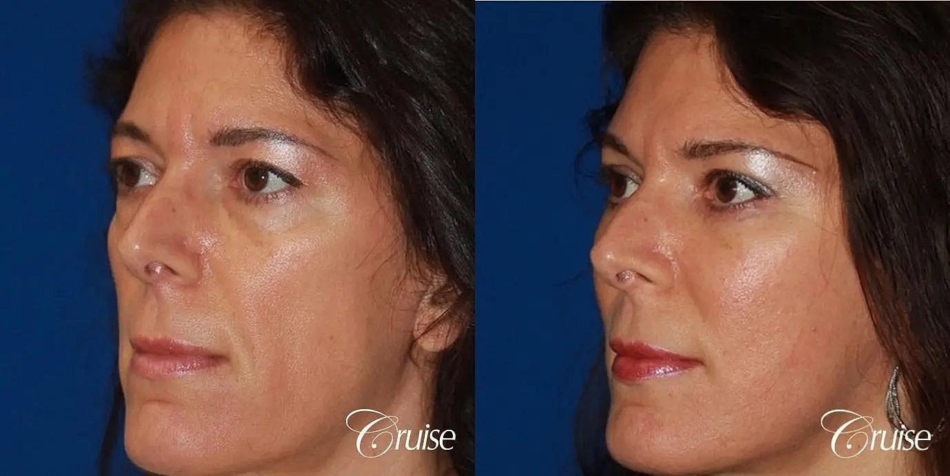 Facial Fat Transfer Before & After